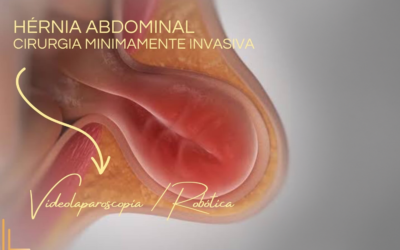 Hérnia Abdominal – Cirurgia Minimamente Invasiva