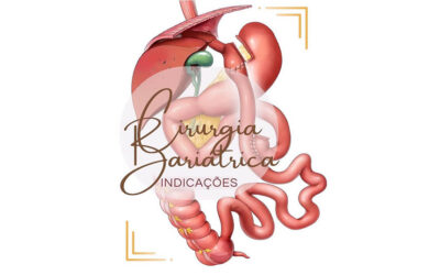 Cirurgia Bariátrica: é indicada para mim?