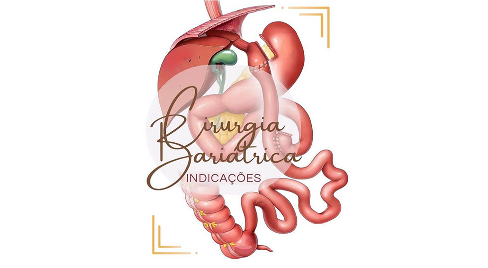 imagem-blog-cirurgia-bariatrica-indicações-paulo-chaib